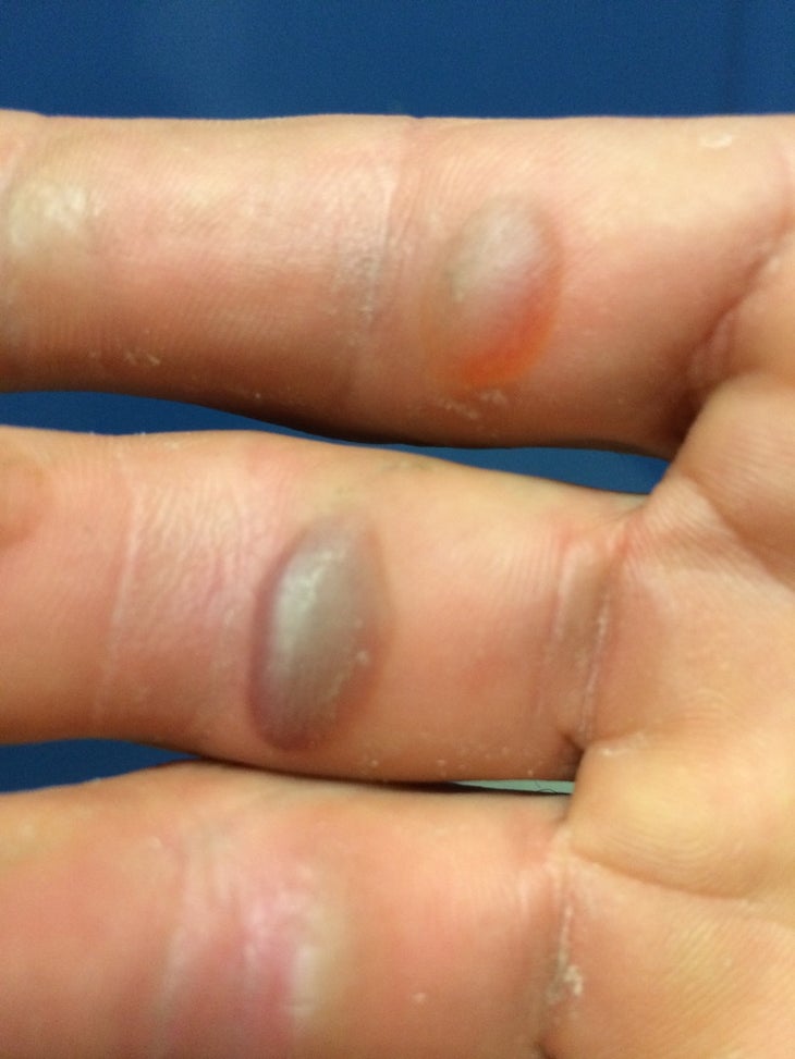 Mayo's fingers, blistered from attempts on the Existensionalist. He could only make one real attempt per day on the route because his fingers would…