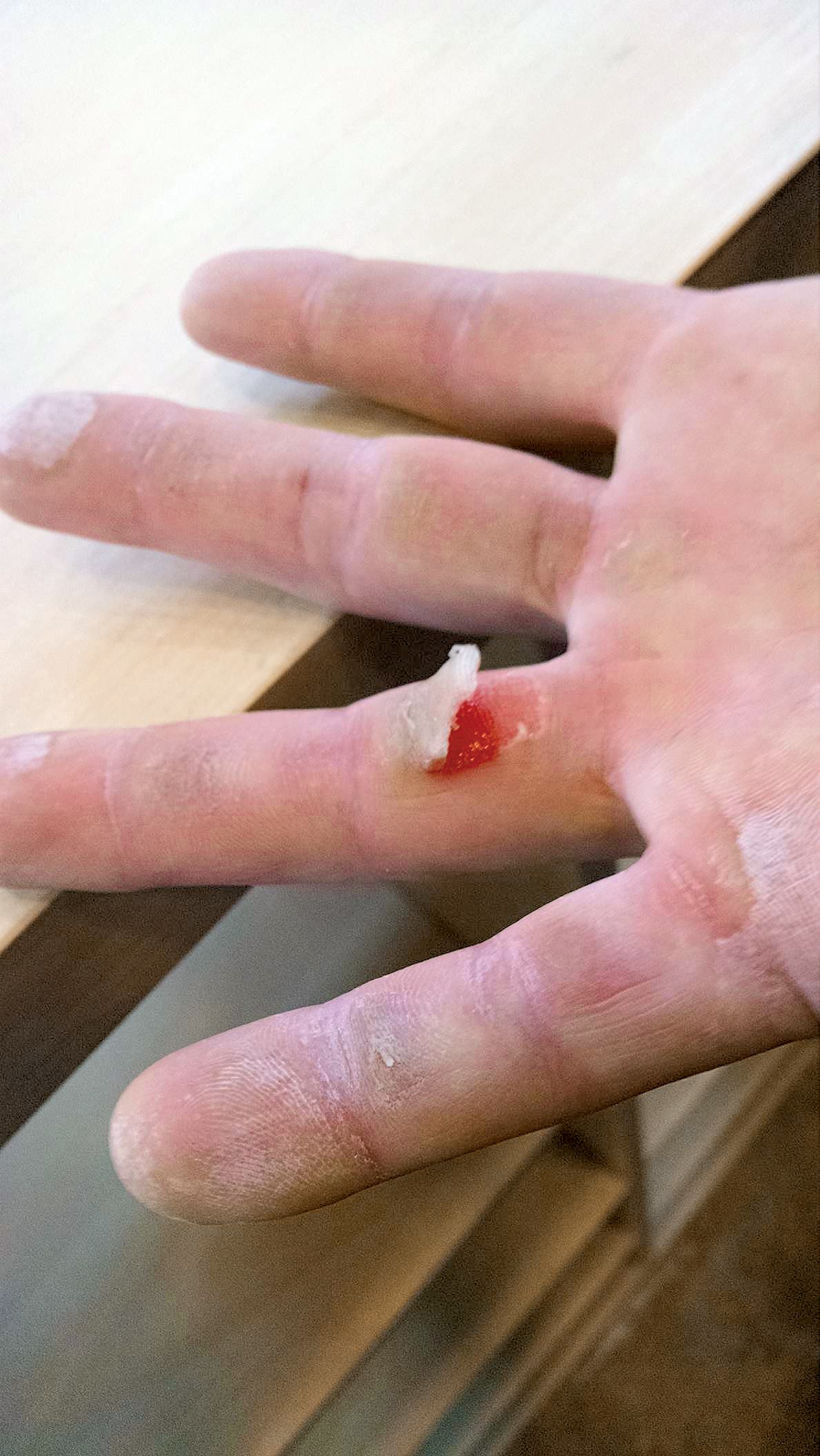Flapper Rock Climbing Finger Skin Injury