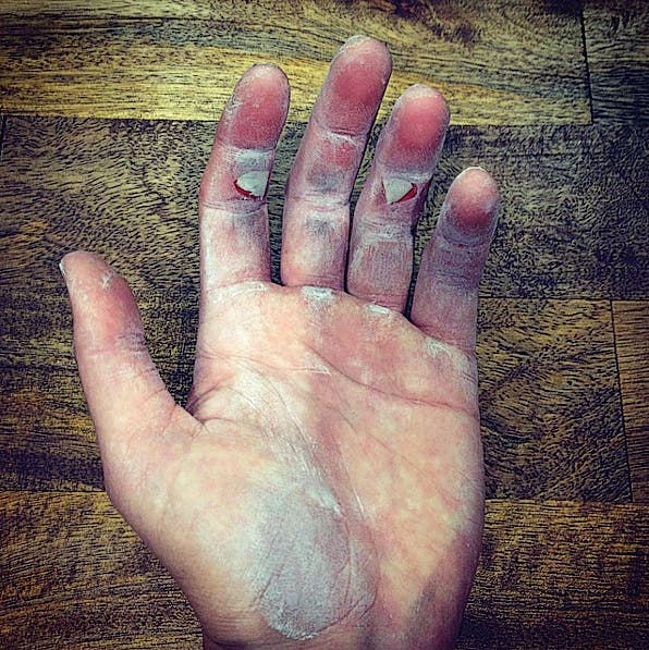 Flapper Rock Climbing Finger Skin Injury