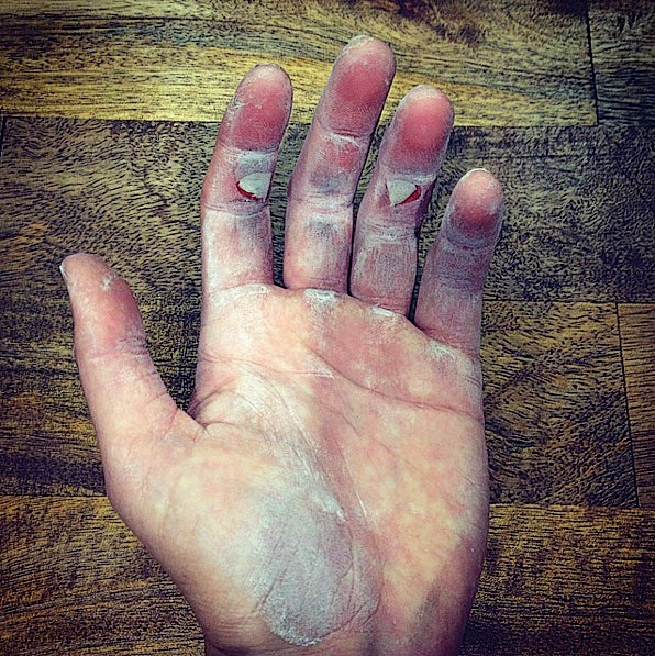 ClaireWalla_gn.jpg Flapper Rock Climbing Finger Skin Injury