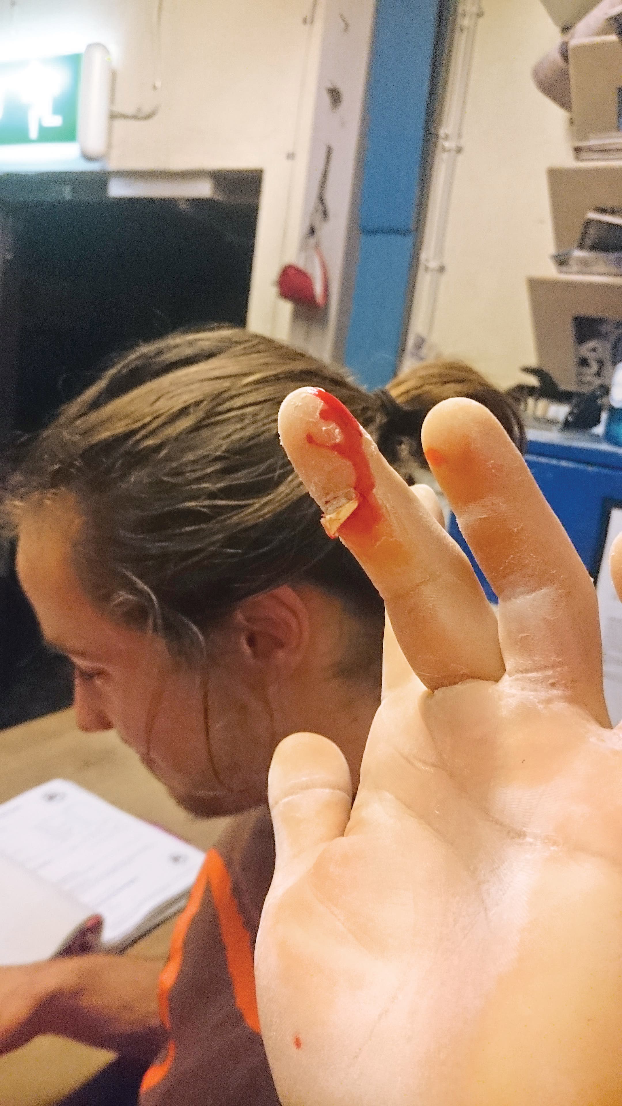 Flapper Rock Climbing Finger Skin Injury