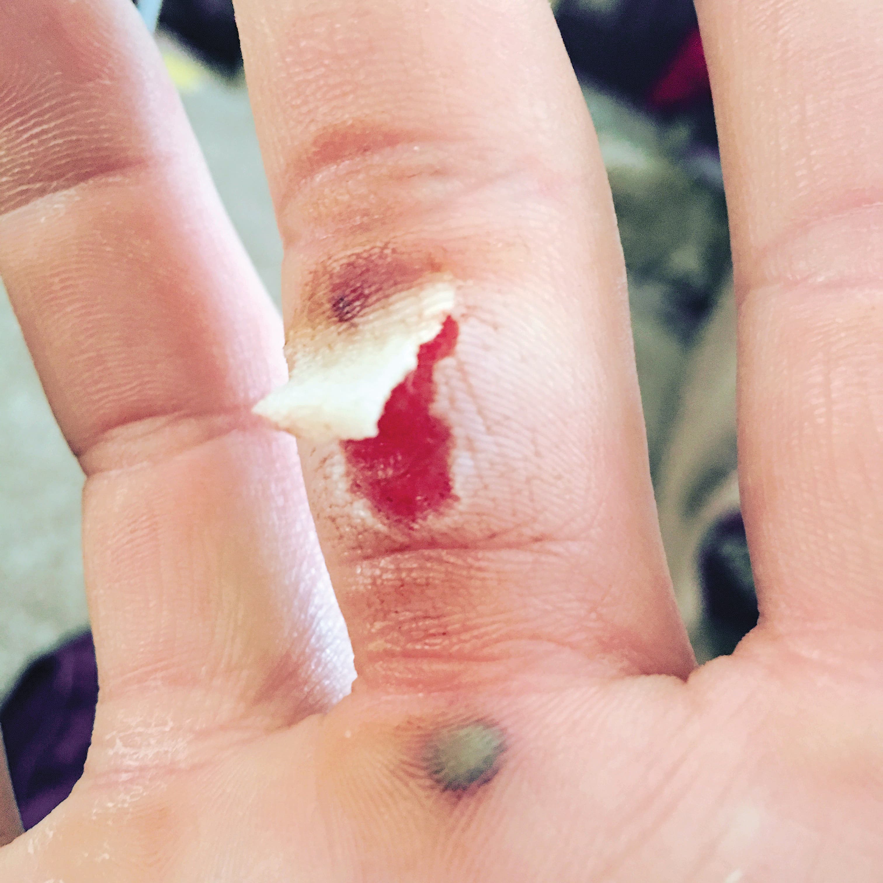 Flapper Rock Climbing Finger Skin Injury