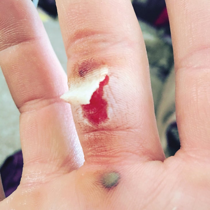 Jacob McHargue_gn.jpg Flapper Rock Climbing Finger Skin Injury
