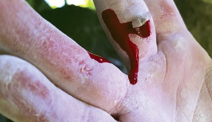 MylesByam.jpg Flapper Rock Climbing Finger Skin Injury