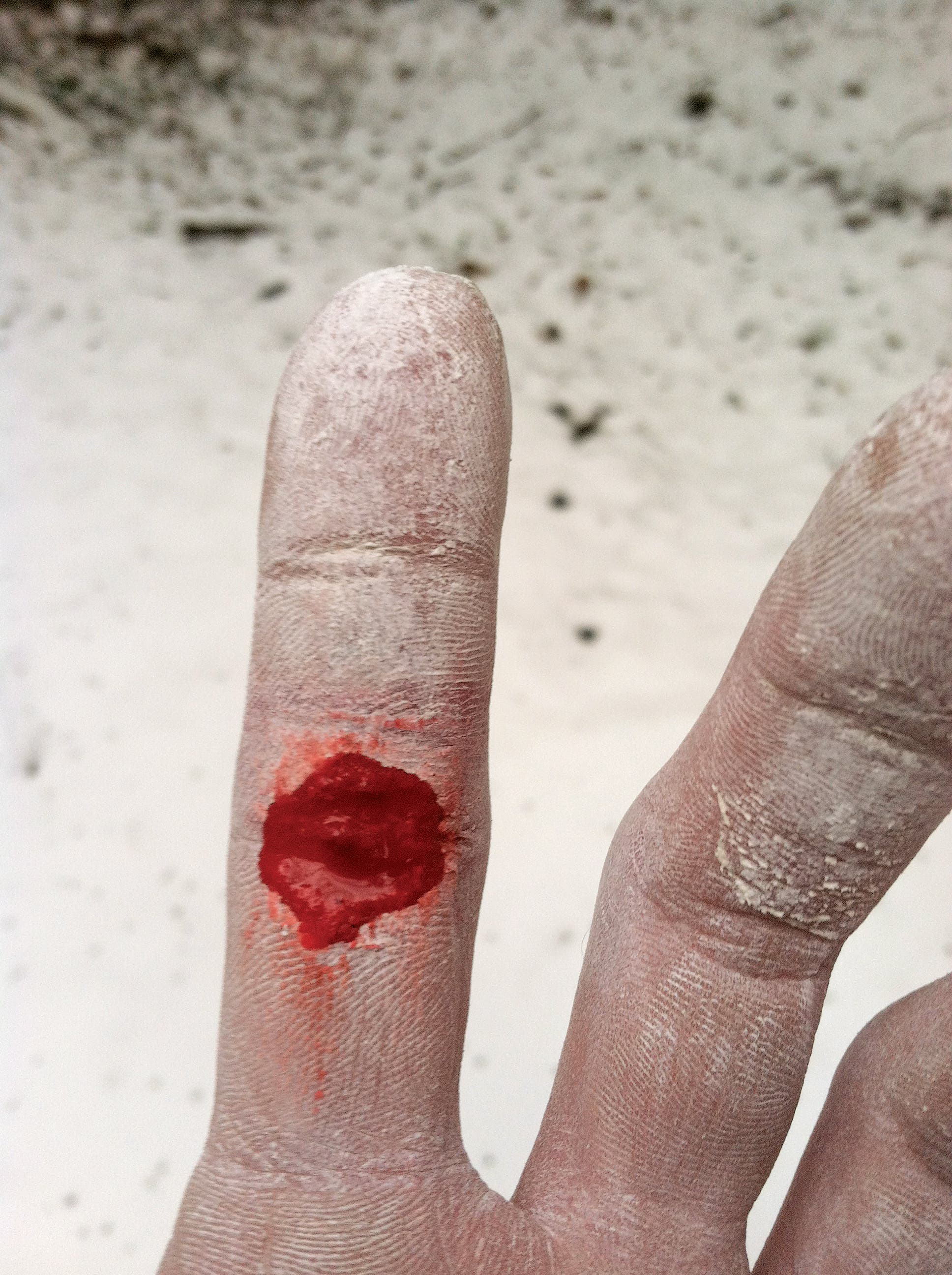 Nick Hodder_gn.jpg Flapper Rock Climbing Finger Skin Injury