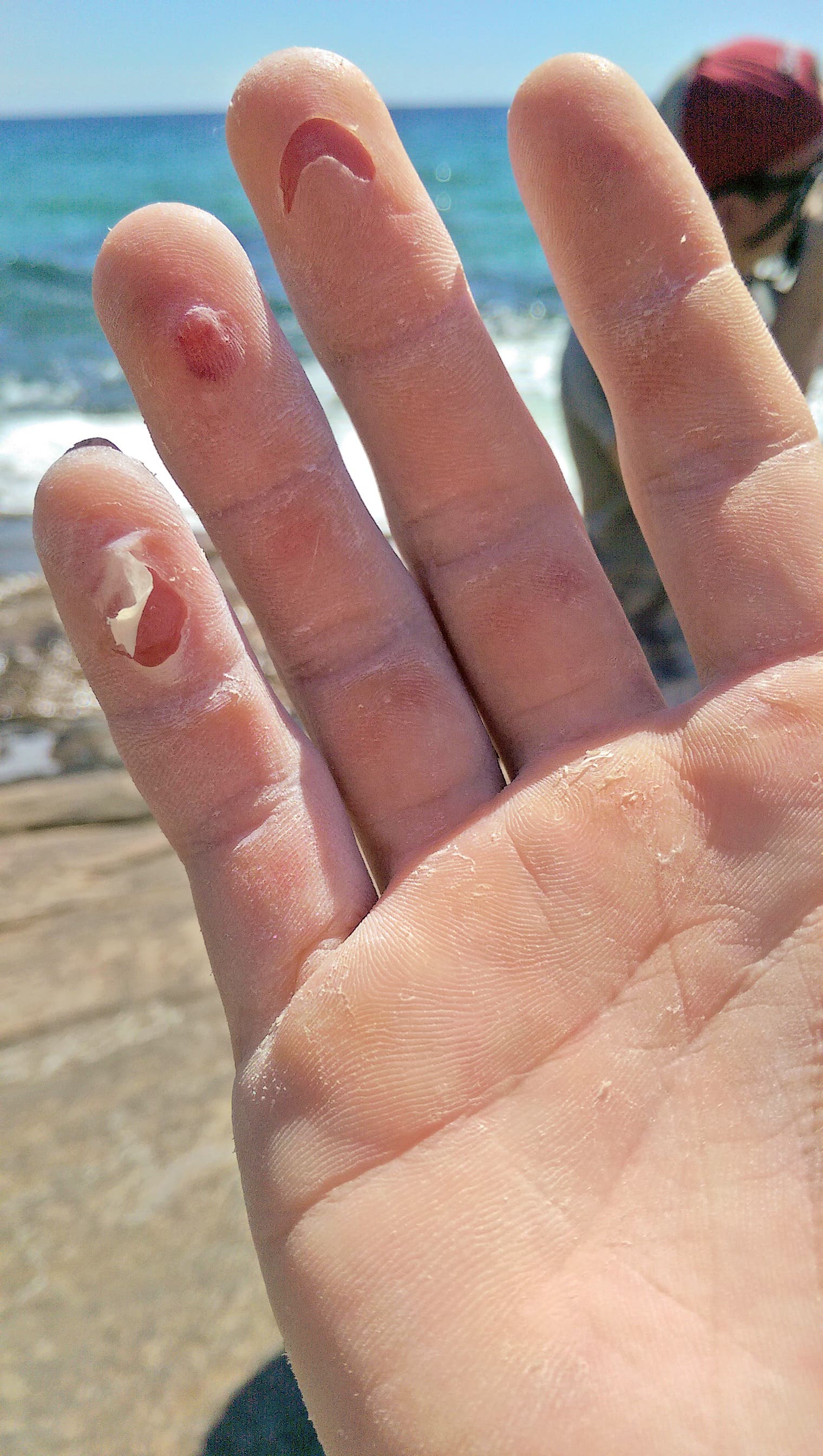 Reece Bright_gn.jpg Flapper Rock Climbing Finger Skin Injury