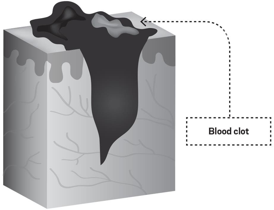 A Dermatologist's Tricks For Healing Skin Injuries From Climbing