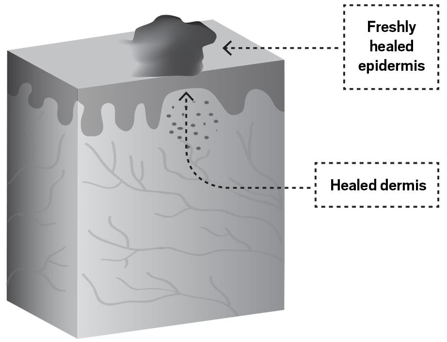 A Dermatologist's Tricks For Healing Skin Injuries From Climbing