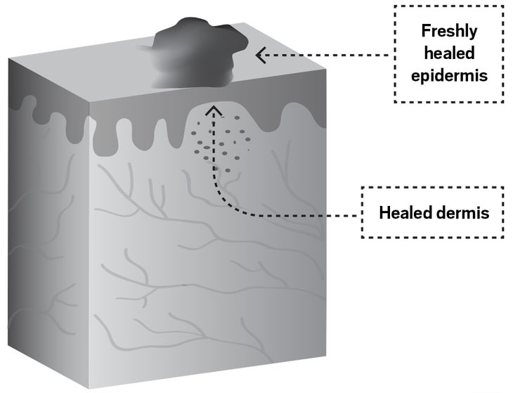 Wound4.jpg Skin healing cycle illustration