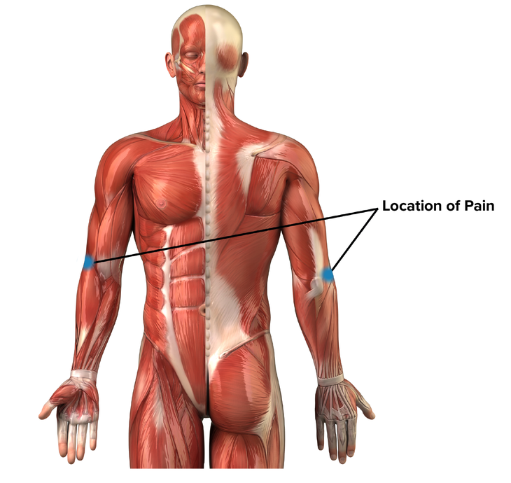 Outside Elbow Pain The Rock Rehab Pyramid