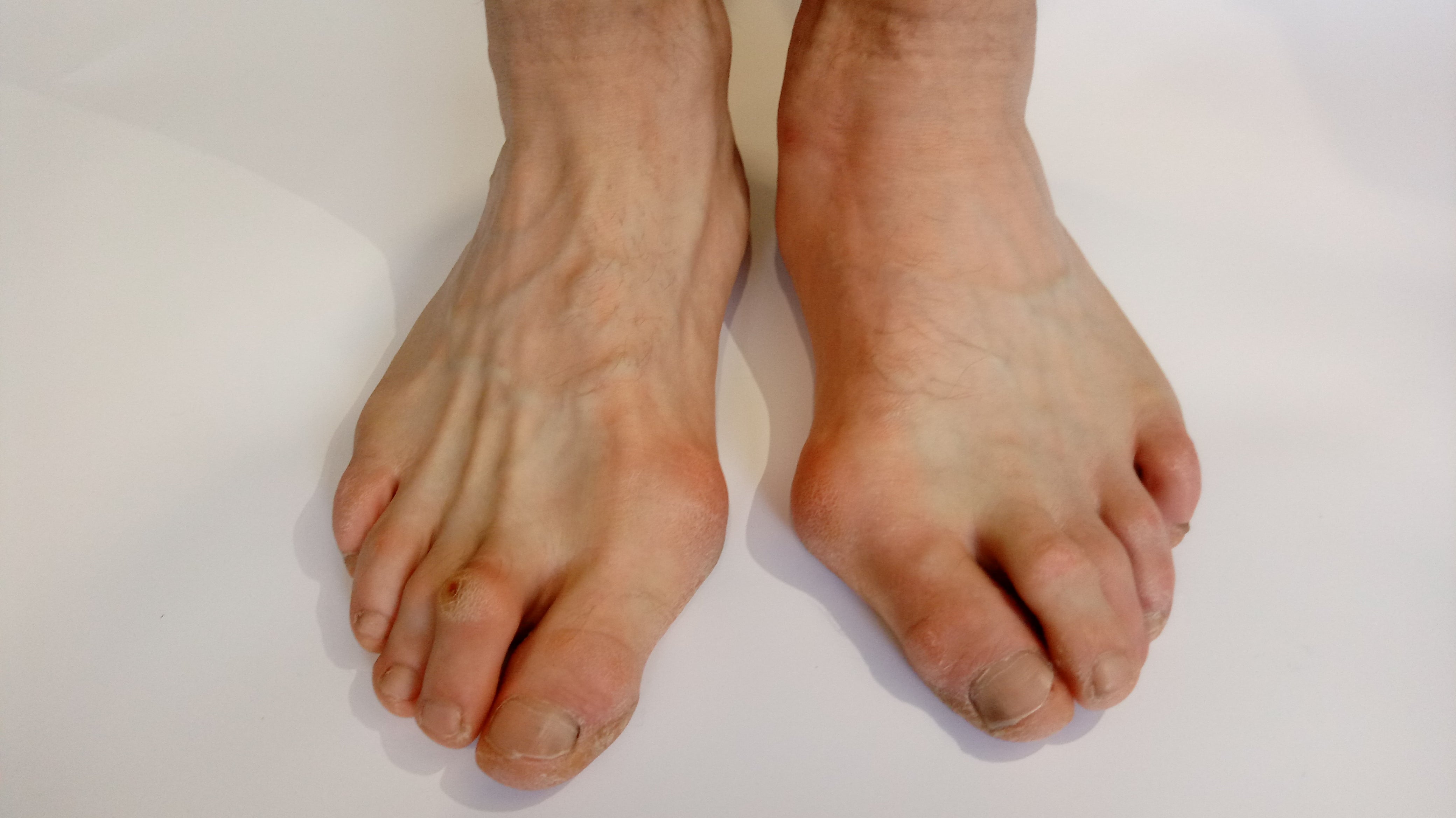 Bunions and Hammer toes - Christopher Miller