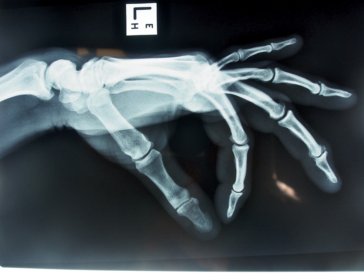An X-ray image of a hand with arthritis from climbing.