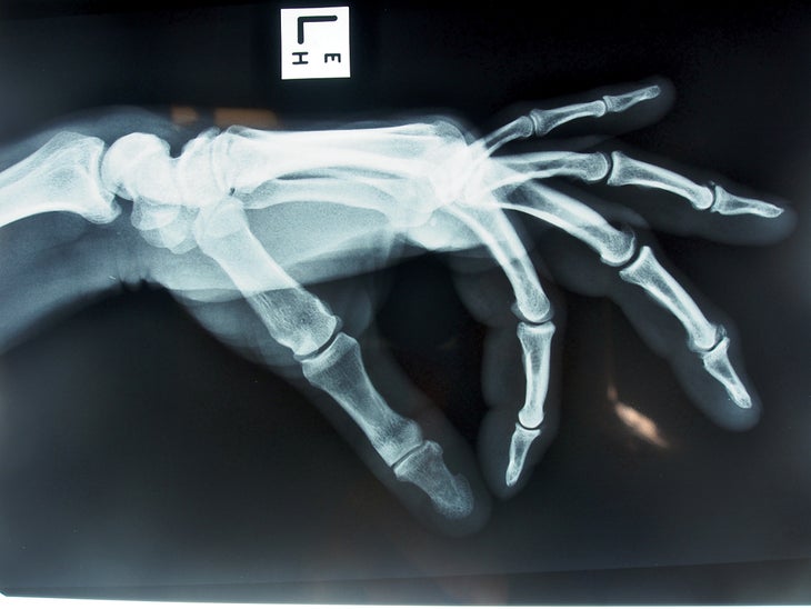 An X-ray image of a hand with arthritis from climbing.