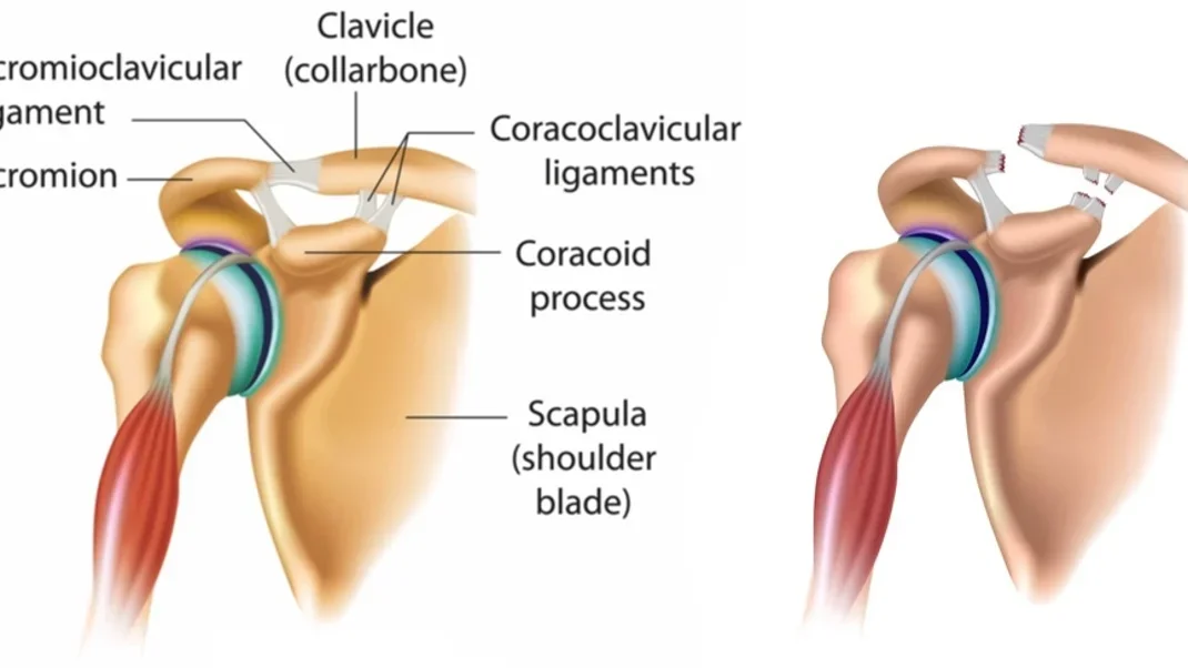 So You've Separated Your Shoulder—Now What?