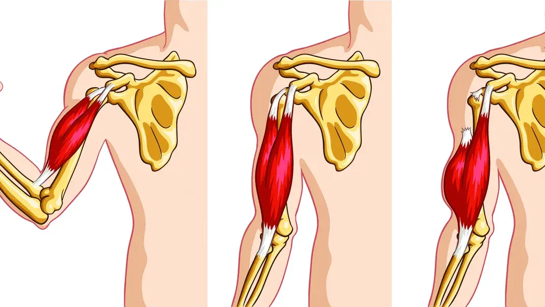 The Biceps Tendon: Why It Blows Out and How to Fix It - Climbing