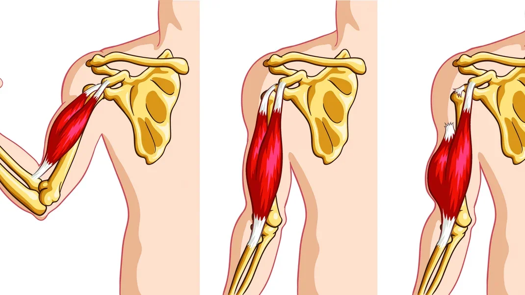 The Biceps Tendon and Climbing: Why It Blows Out and How to Fix It