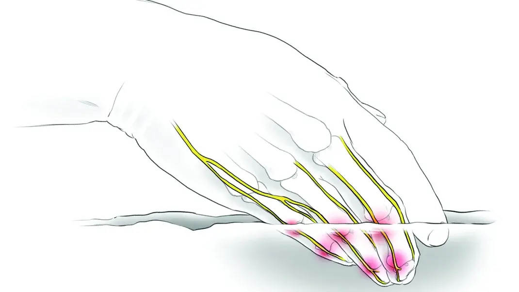 Diagram of finger and hand nerve damage.
