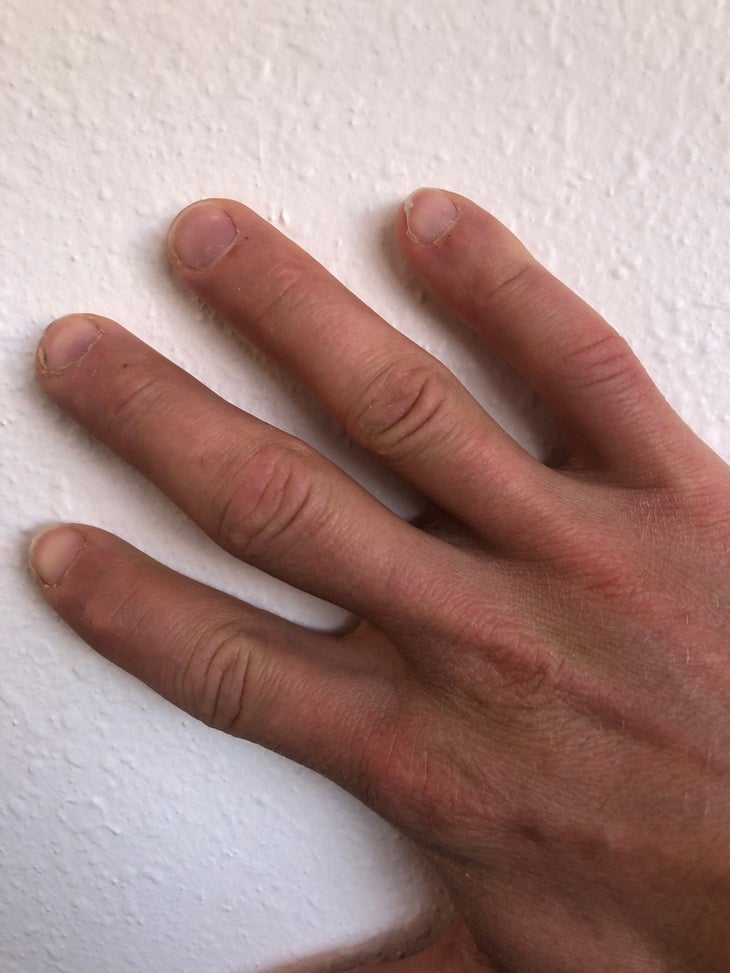 bruised middle finger