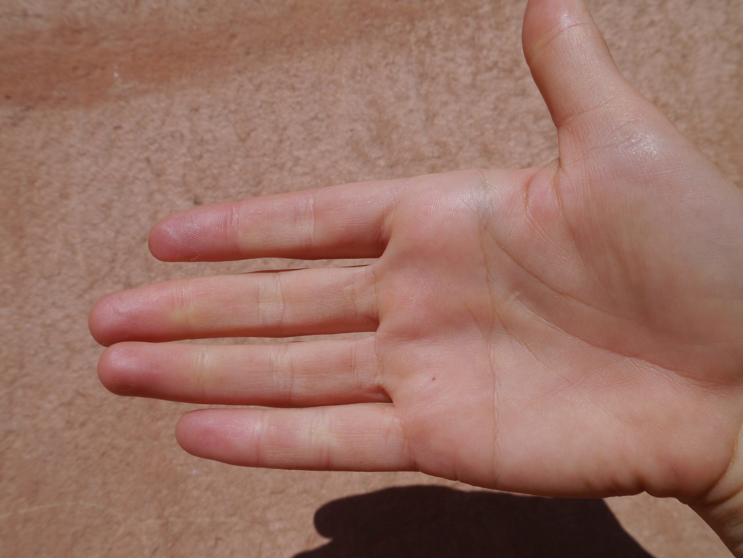 Broken Finger vs Jammed Finger: How to Tell the Difference