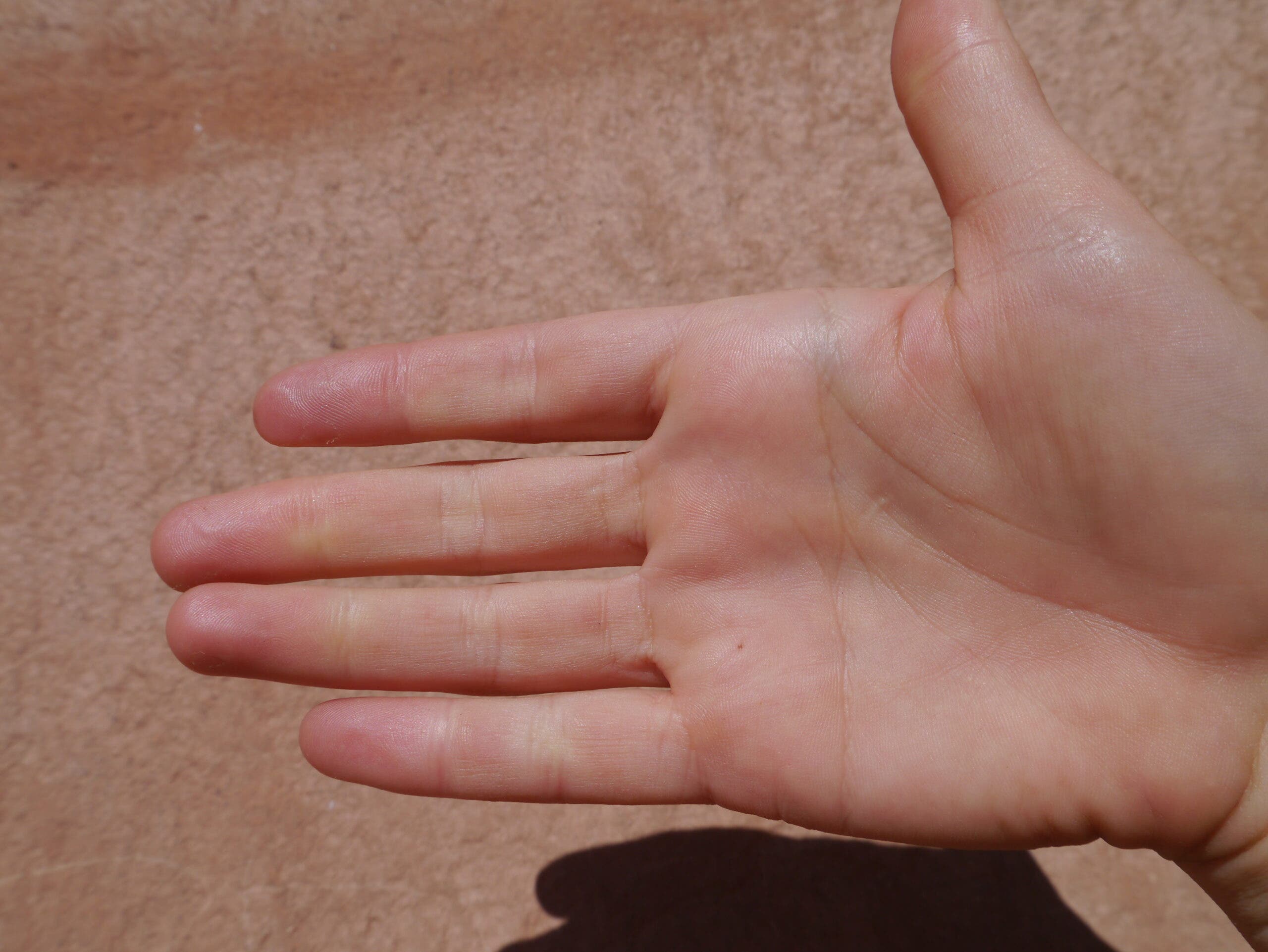 How to tell if you have a finger injury - Climbing