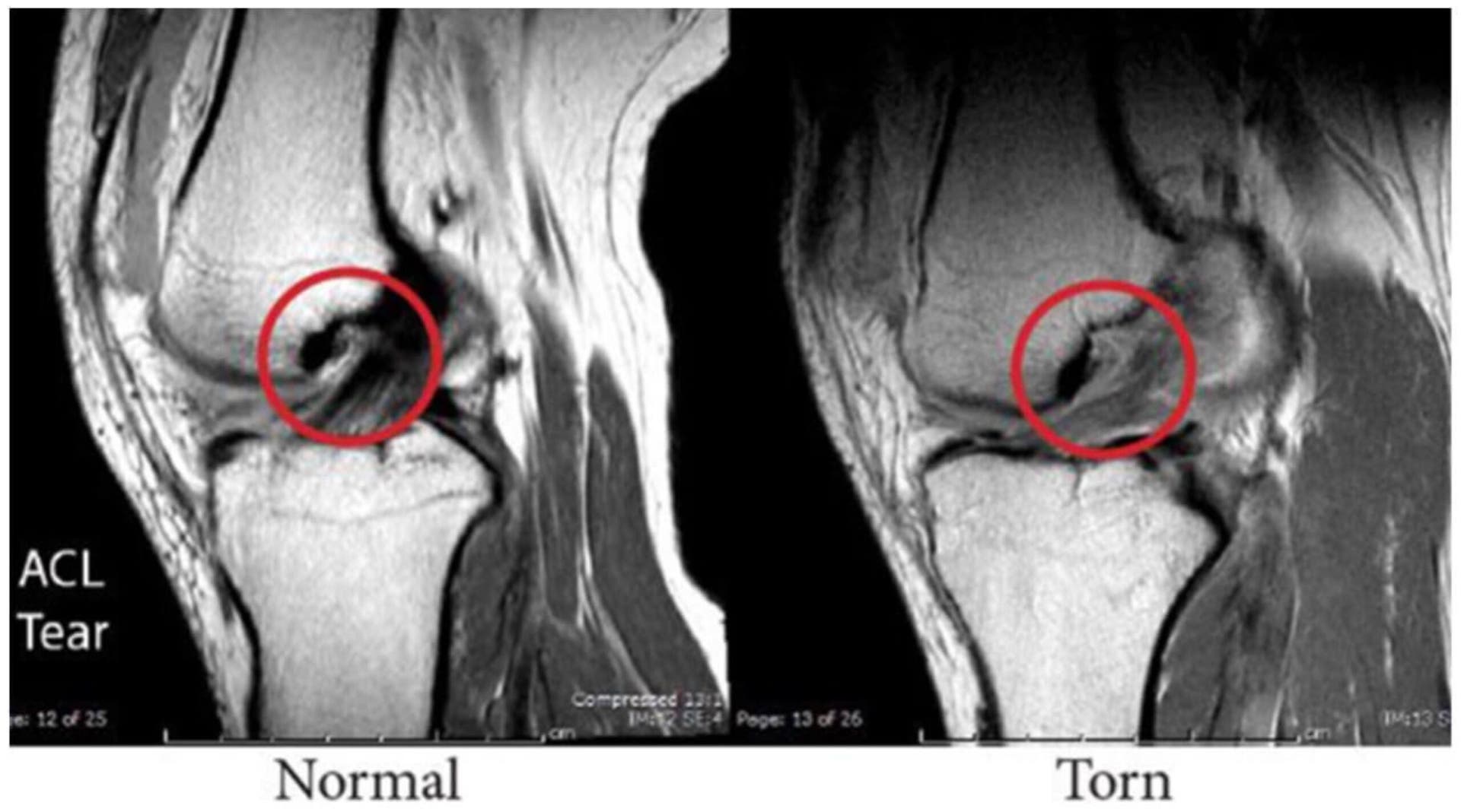 How to Rehab An ACL Tear for Climbing - Climbing