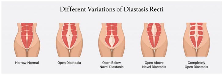 diagram of diastasis recti abdominis