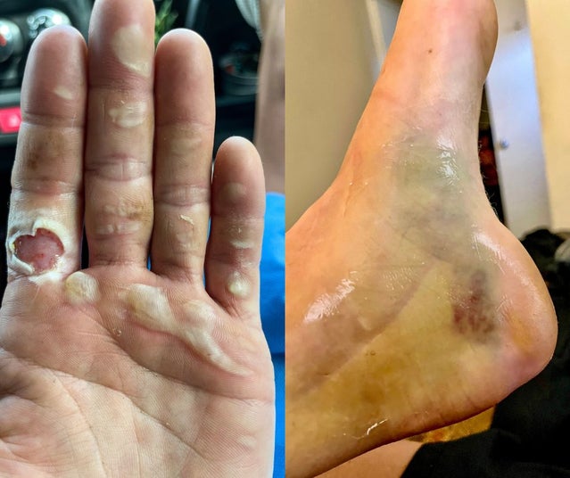 Whitney Clark's rope-burned hand and bruised heel after her fall.