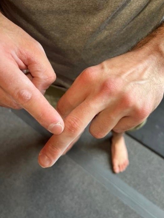 A man's hand points at the back of an index finger where pain can occur in climbers.