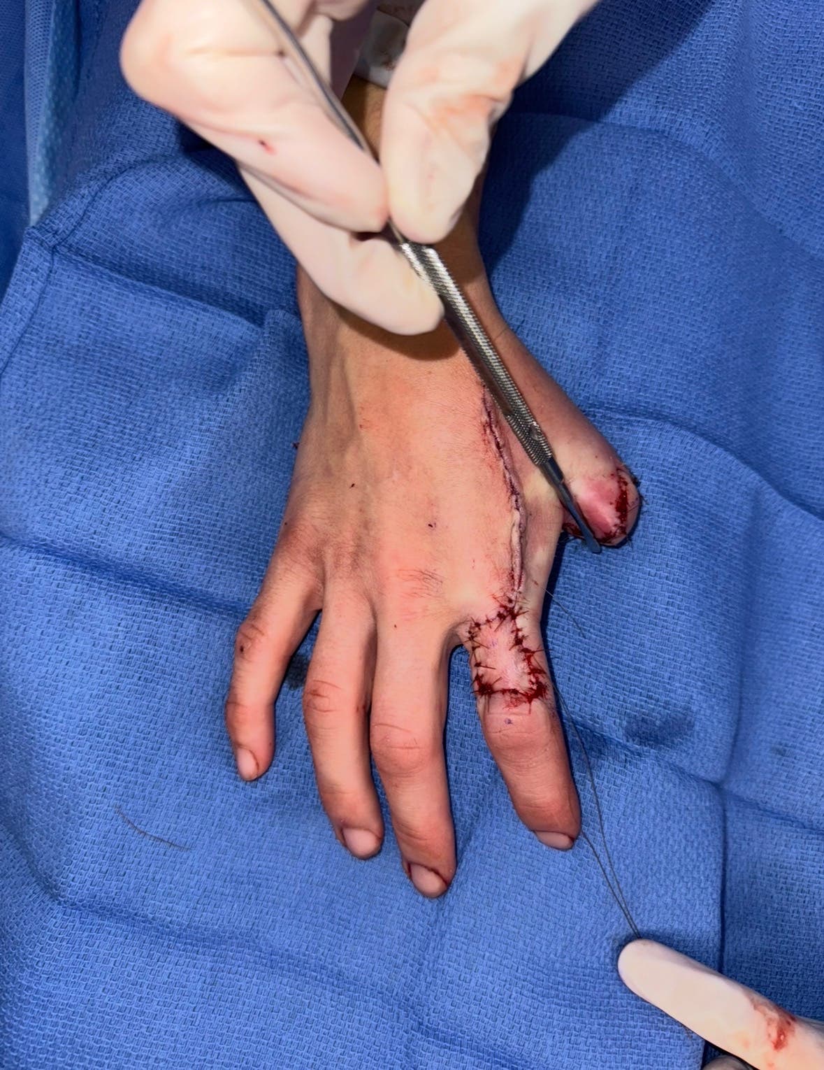 Lorenz's thumb after the re-amputation surgery